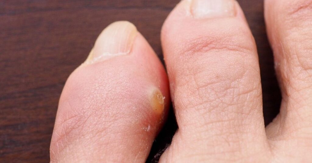 Likdoorn behandeling – pedicure en preventie