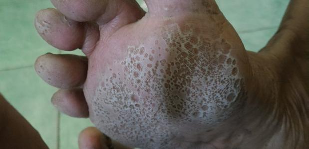 voet met putjeszolen pitted keratolysis