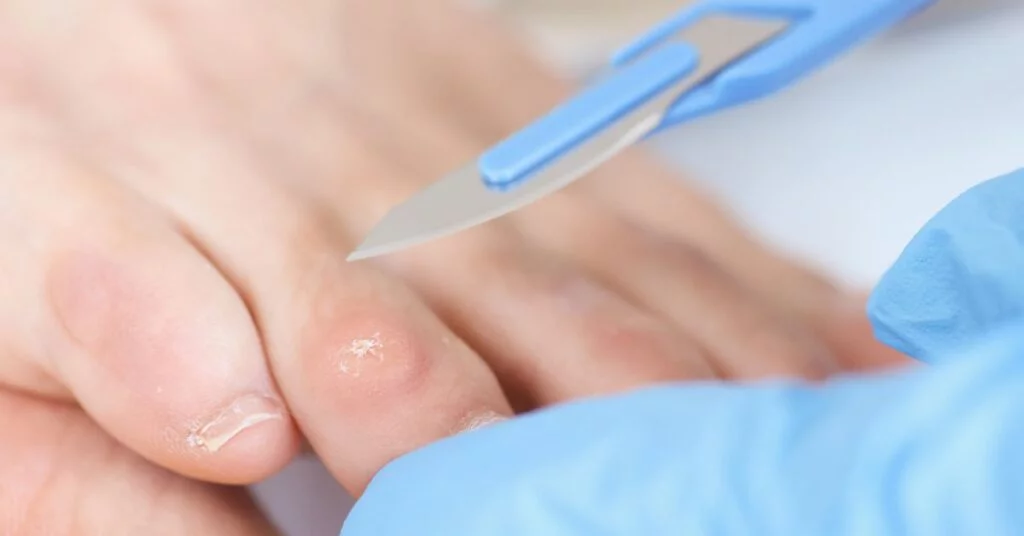 Likdoorn verwijderen door pedicure